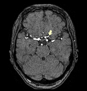 頭部MRI&MRA検査：前大脳動脈瘤＋中大脳動脈奇形