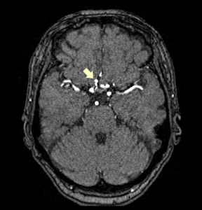 頭部MRI&MRA検査：前大脳動脈瘤＋中大脳動脈奇形