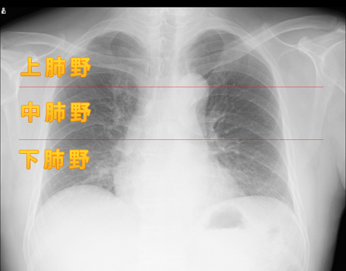 胸部レントゲンにおける肺区域