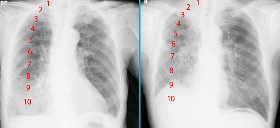COPDと肺線維症