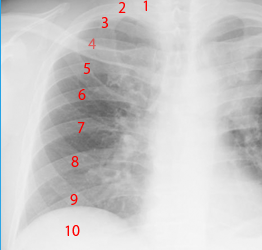 後肋骨9番から10番の位置が横隔膜の正常位置