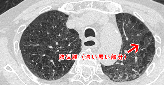 慢性閉塞性肺疾患・COPD