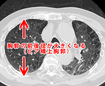 慢性閉塞性肺疾患・ビア樽上胸郭