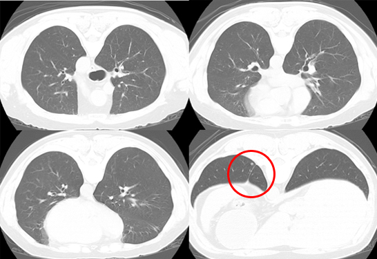 仰臥位による肺CT撮影