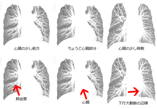 肺紋理のイメージ