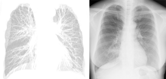 肺紋理の比較