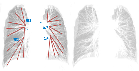 肺紋理と肺動脈の走行