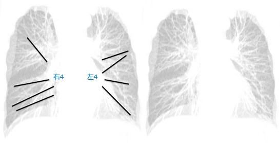 肺紋理と肺静脈