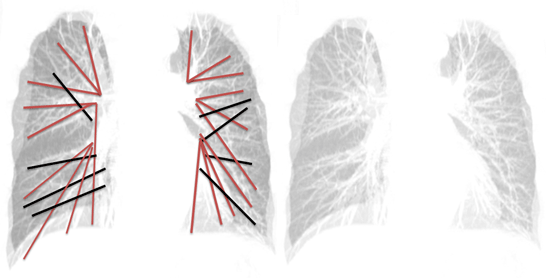 肺紋理の全体イメージ
