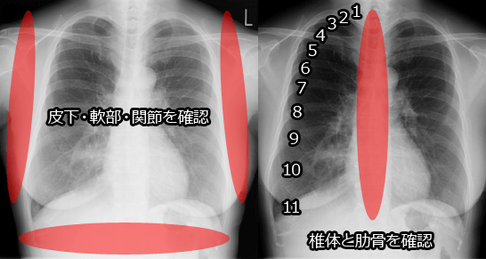 胸部X線写真の読影方法