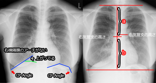 最愛 胸部X線写真の判断基準異常の見つけ方 健康/医学 - education