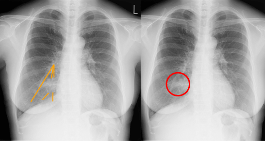 胸部X線の読影方法