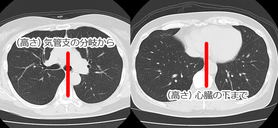 奇静脈食道線（CT画像）