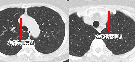右某気管支腺と左鎖骨下動脈（CT画像）