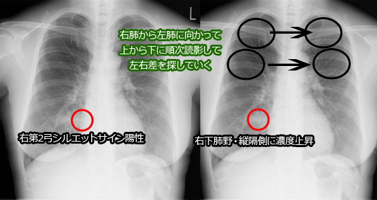 胸部X線の読影方法