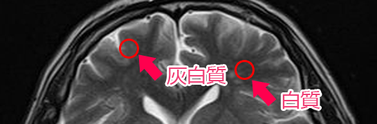 灰白質と白質（MRI）