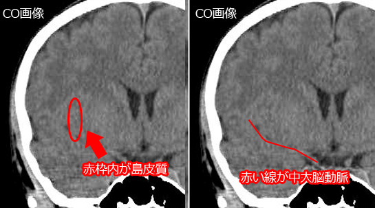 中大脳動脈（MCA）と島皮質
