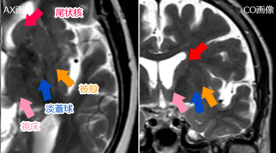 淡蒼球、視床、尾状核等（MRI）