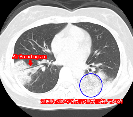 マイコプラズマ　胸部CT