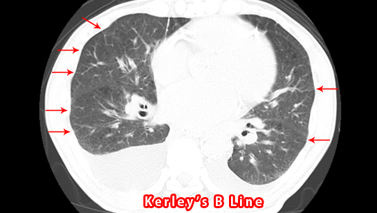 Kerley’s B Line　CT画像