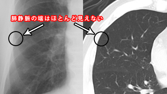 肺静脈のXPとCT