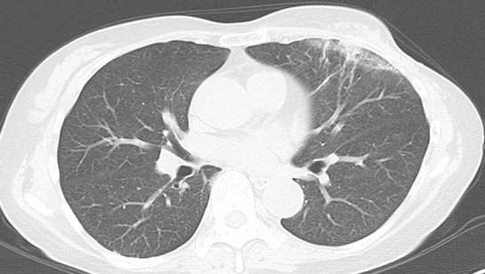放射線肺炎の胸部CT
