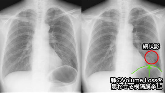 放射線肺炎の胸部レントゲン