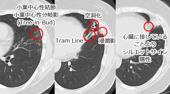 NTM（非結核性抗酸菌症）胸部CT