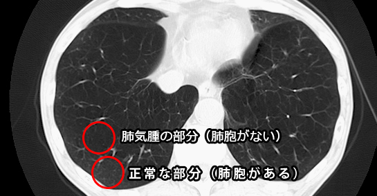 肺気腫　CT画像
