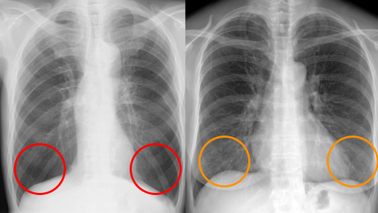 肺気腫　正常例と比較