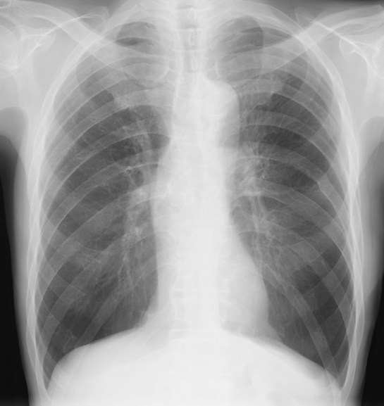 肺気腫　胸部レントゲン
