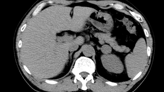 副腎腫瘍のCT画像