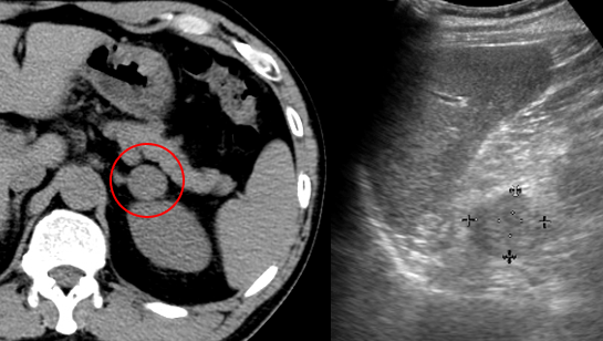 副腎腫瘍のCT・US画像
