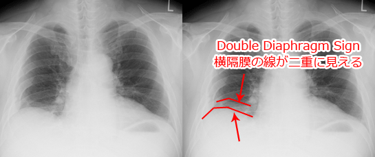 Double-Diaphragm-Sign