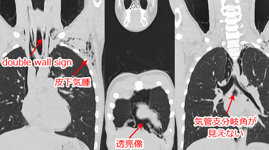 縦隔気腫のCT画像