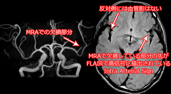Intra Arterial SignのMRI、FLAIR画像