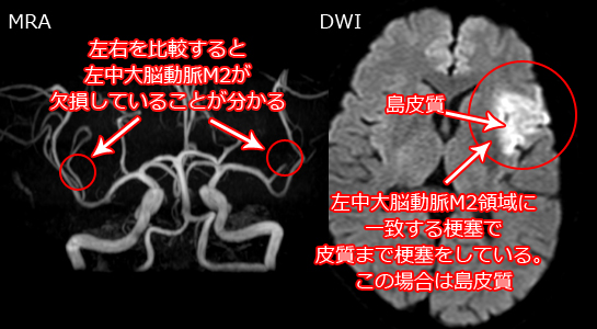 心原性塞栓症のMRI