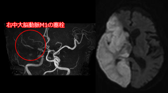 心原性塞栓症のMRI