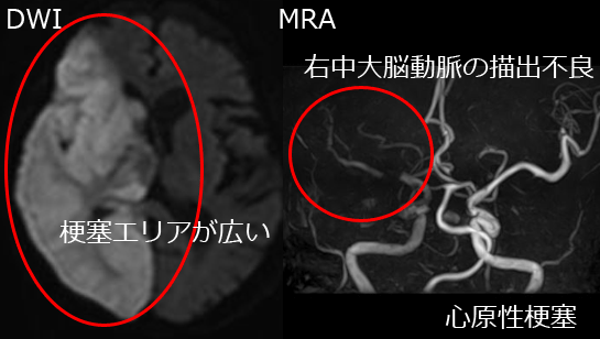 脳梗塞・心原性梗塞MRI