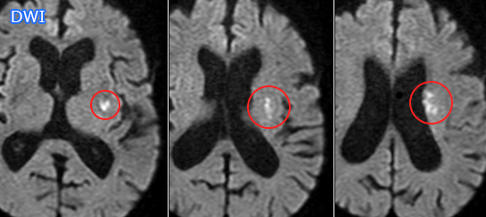 分枝粥腫型梗塞（BAD）MRI画像