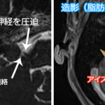 聴神経腫瘍の造影MRI
