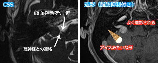 聴神経腫瘍の造影MRI