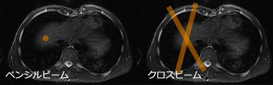 冠動脈（心臓）MRIのナビゲーター