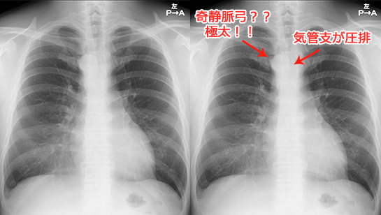 右大動脈弓の胸部X線（レントゲン）