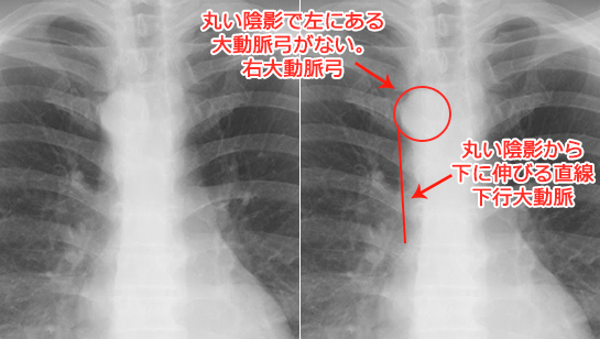 右大動脈弓の胸部X線（レントゲン）