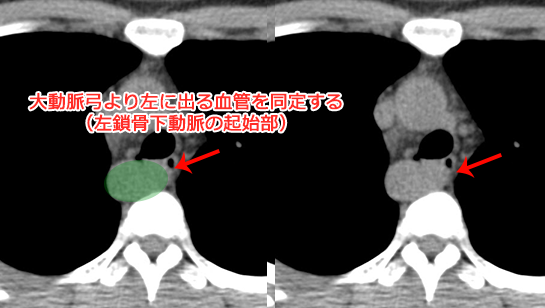 右動脈弓の胸部CT画像