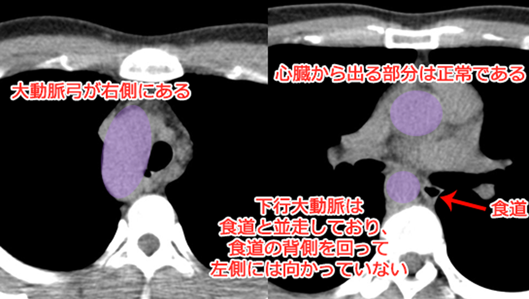 右大動脈弓　胸部CT画像（縦隔条件）