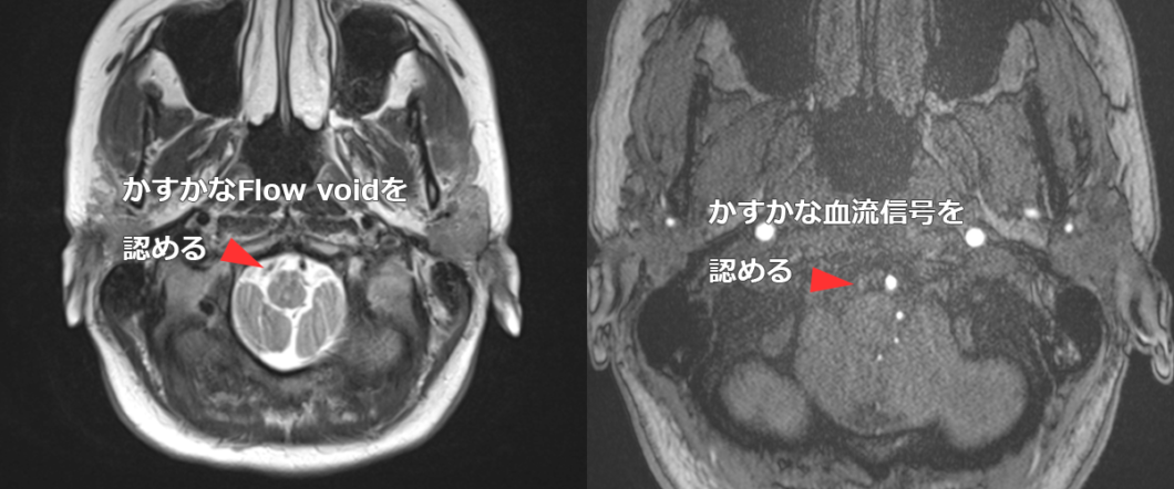 頭部MRI画像（T2WIおよびMRA）