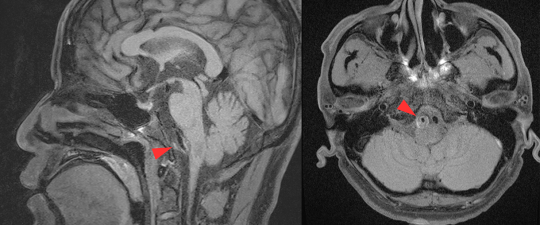 脂肪抑制T1強調画像（T1WI）Black Blood（Vessel wall image）