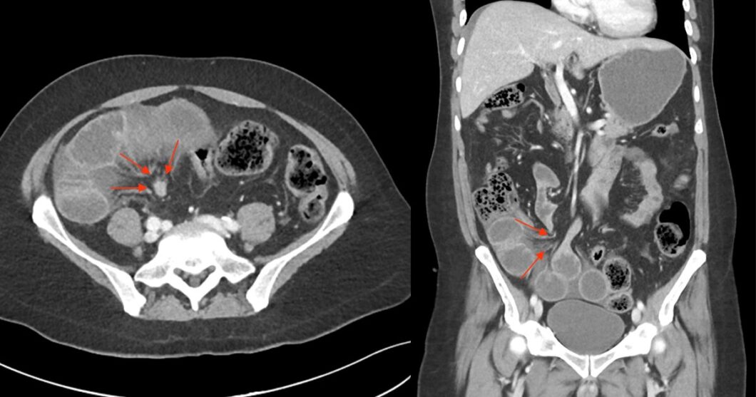 腸閉塞で腸間膜浮腫がある場合は、中心点を探す